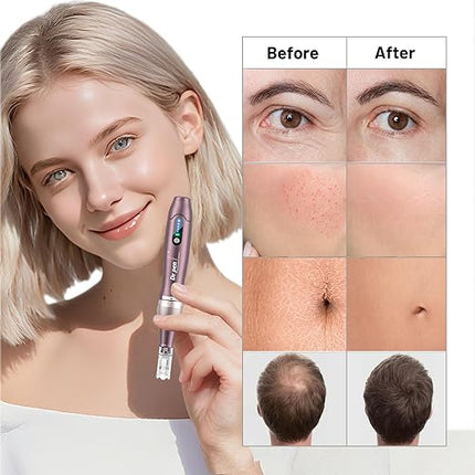 Dr. Pen Ultima A10 Microneedling Pen mit 25 Kartuschen Kabellos
